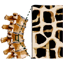 Zobraziť obrázok: Kosť postihnutá osteoporózou